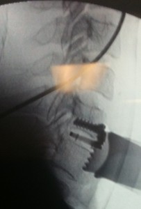 Απεικόνηση αυχενικού δίσκου