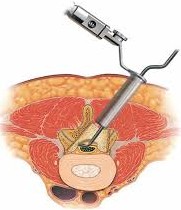Minimal Invasive Surgery